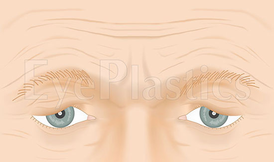 Image showing normal eyebrow position