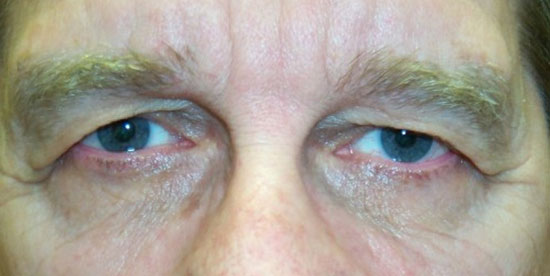 A close-up image showing a person's eye with drooping eyebrows, indicating brow ptosis.